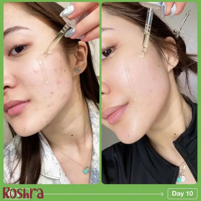 سرم آزلائیک اسید 10% و هیالورون آنوا image